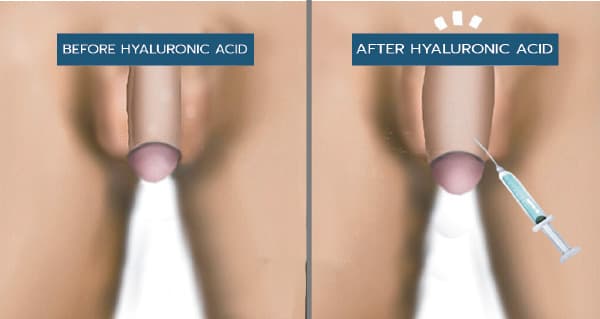 What is Penile Girth Enhancement with Filler?